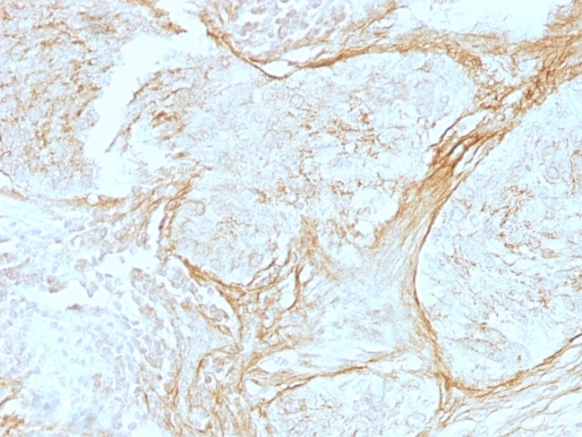 Tenascin C (Stromal Marker for Epithelial Malignancy) Antibody in Immunohistochemistry (Paraffin) (IHC (P))