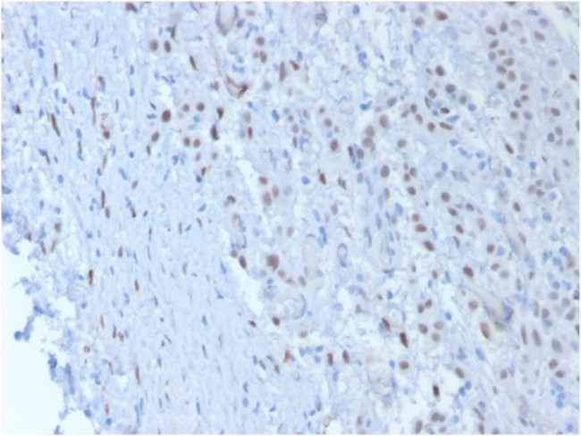 Wilm's Tumor 1 (WT1) (Wilm's Tumor and Mesothelial Marker) Antibody in Immunohistochemistry (Paraffin) (IHC (P))