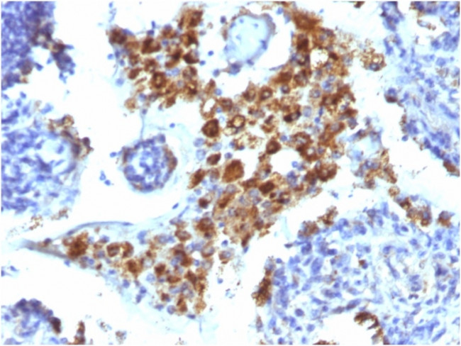 Napsin A (Lung Adenocarcinoma Marker) Antibody in Immunohistochemistry (Paraffin) (IHC (P))